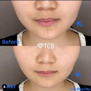 TCB東京中央美容外科の症例写真
