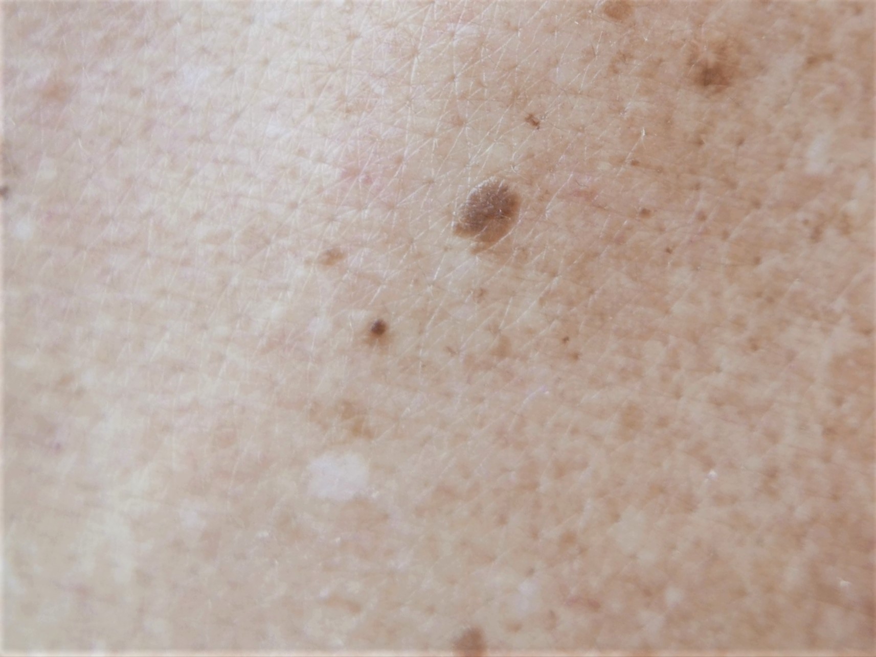 白斑の原因は何ですか？