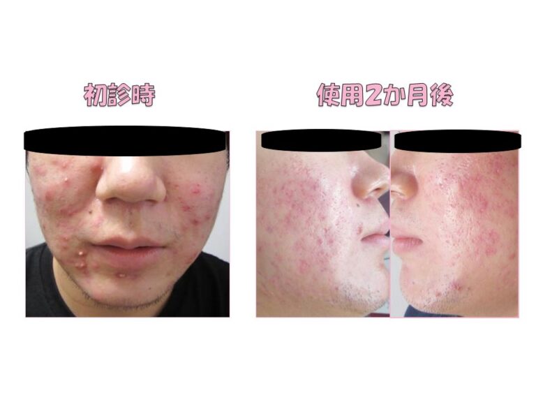 ロアキュテインのリーフレット