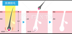 1. 医療脱毛とは