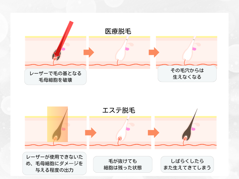 医療脱毛 しくみ
