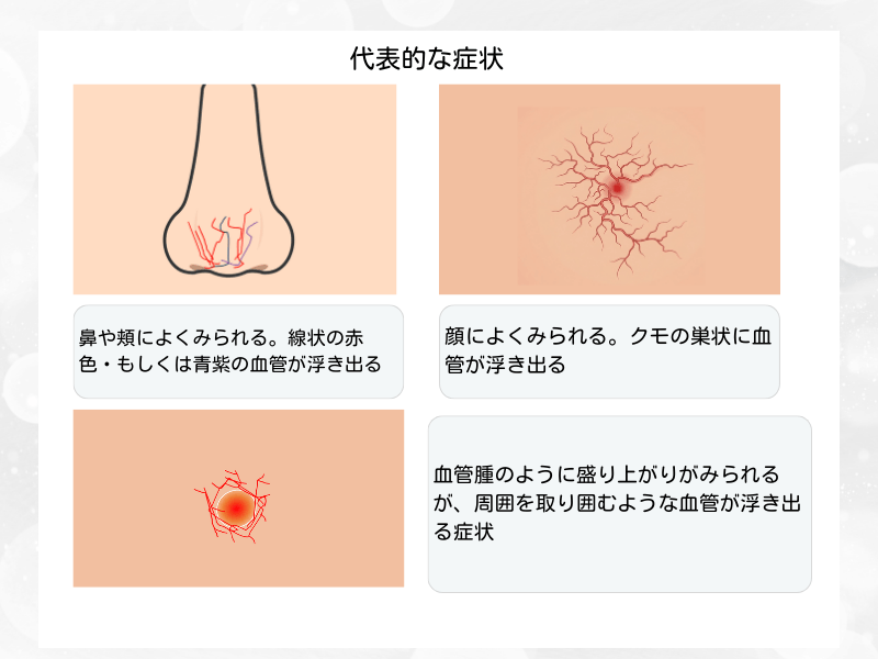 毛細血管拡張症　症状