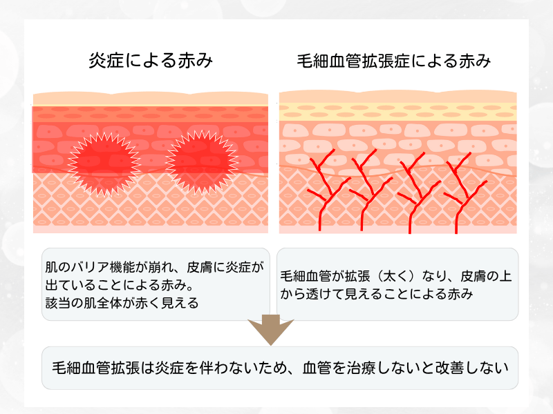 毛細血管拡張症　赤ら顔