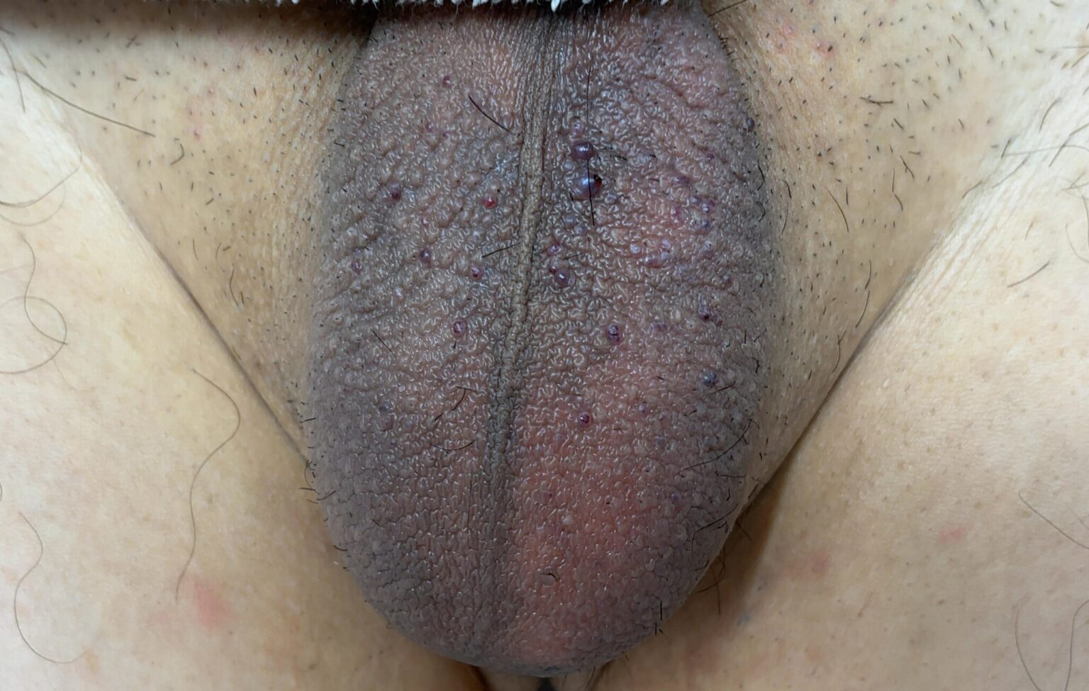 【写真付】陰嚢被角血管腫とは？玉袋にできる黒いブツブツの原因と治し方を医師が解説！ | あつた皮ふ科・美容皮膚科クリニック｜名古屋市中川区の