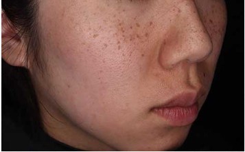 パラパラしたシミ