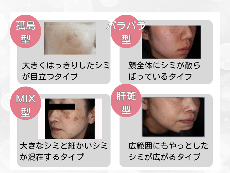 シミの種類 一覧