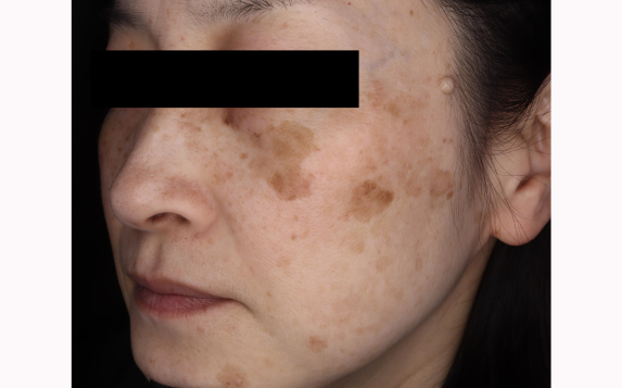 シミ 複数ある写真