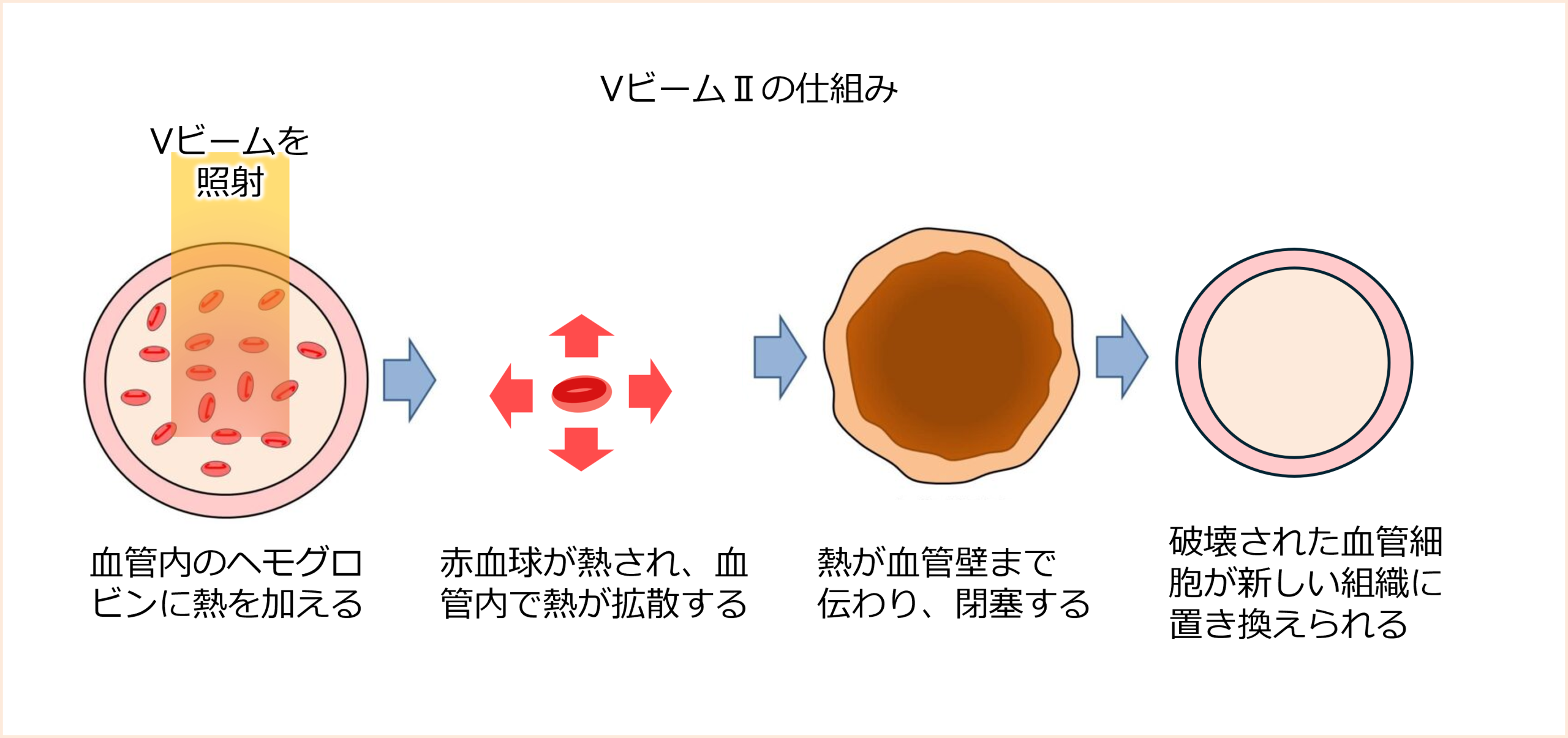 Vビーム　しくみ
