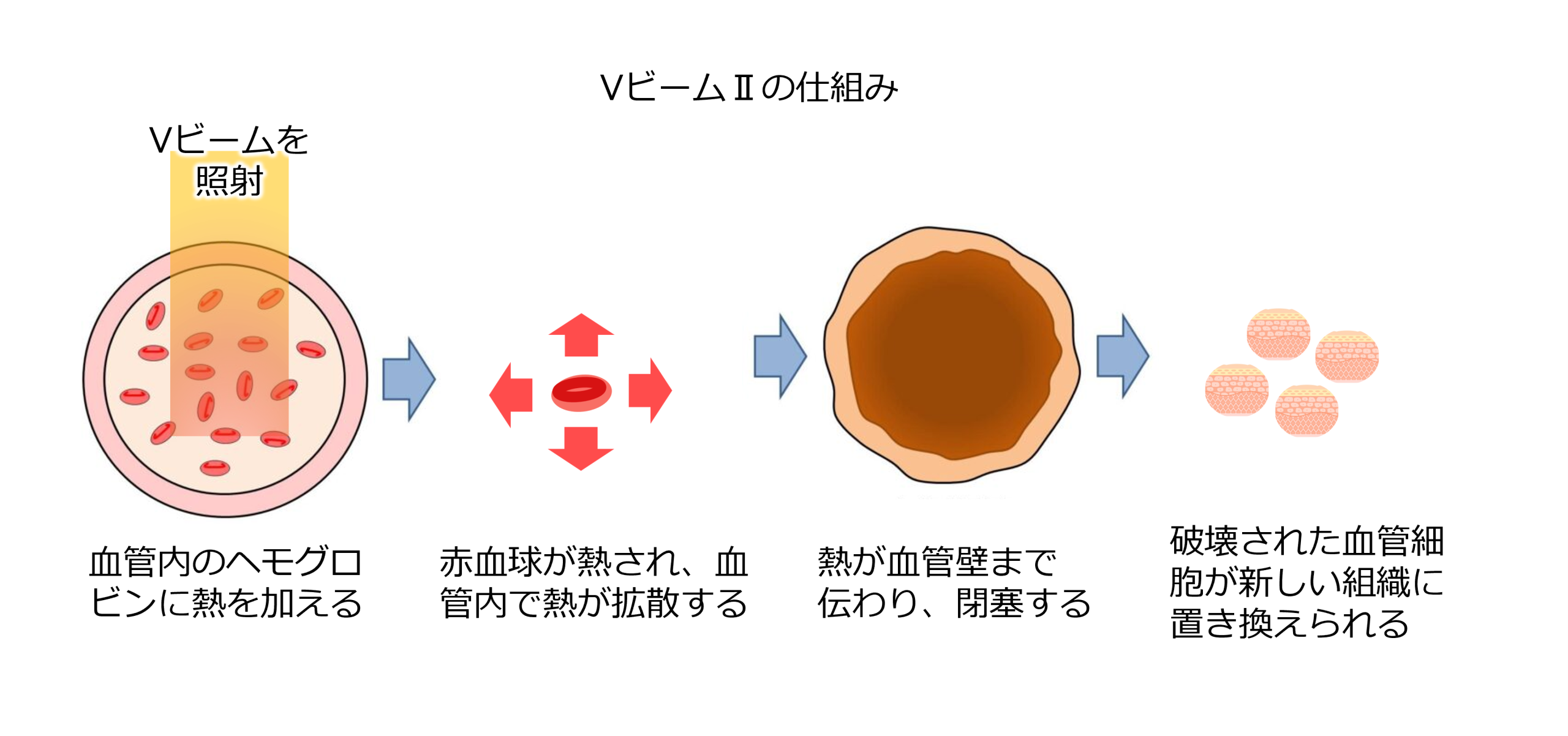 Vビームが効く理由