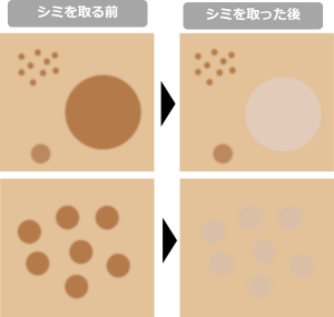 シミは最初から全部取る